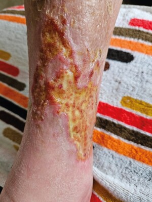 Beenwonden + Exsuderende wonden