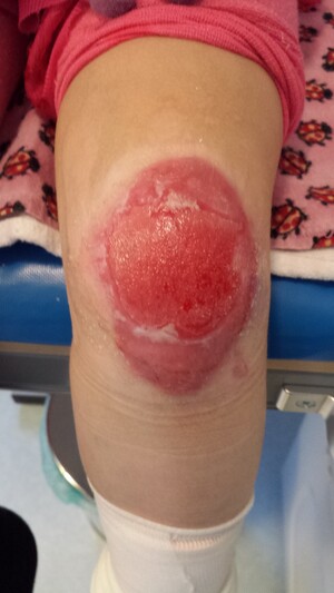 Epidermolysis Bullosa (EB) wonden