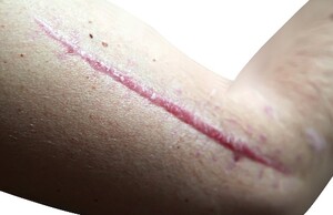 Behandeling van hypertrofische littekens