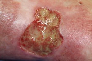 Geïnfecteerde wonden