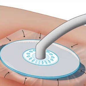 Negatieve Druk Therapie