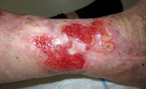 Oppervlakkige wonden