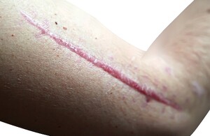 Afwijkende littekens