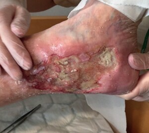 Ulcus Cruris wonden