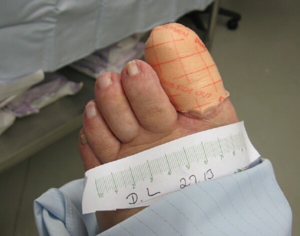 PolyMem op de grote teen